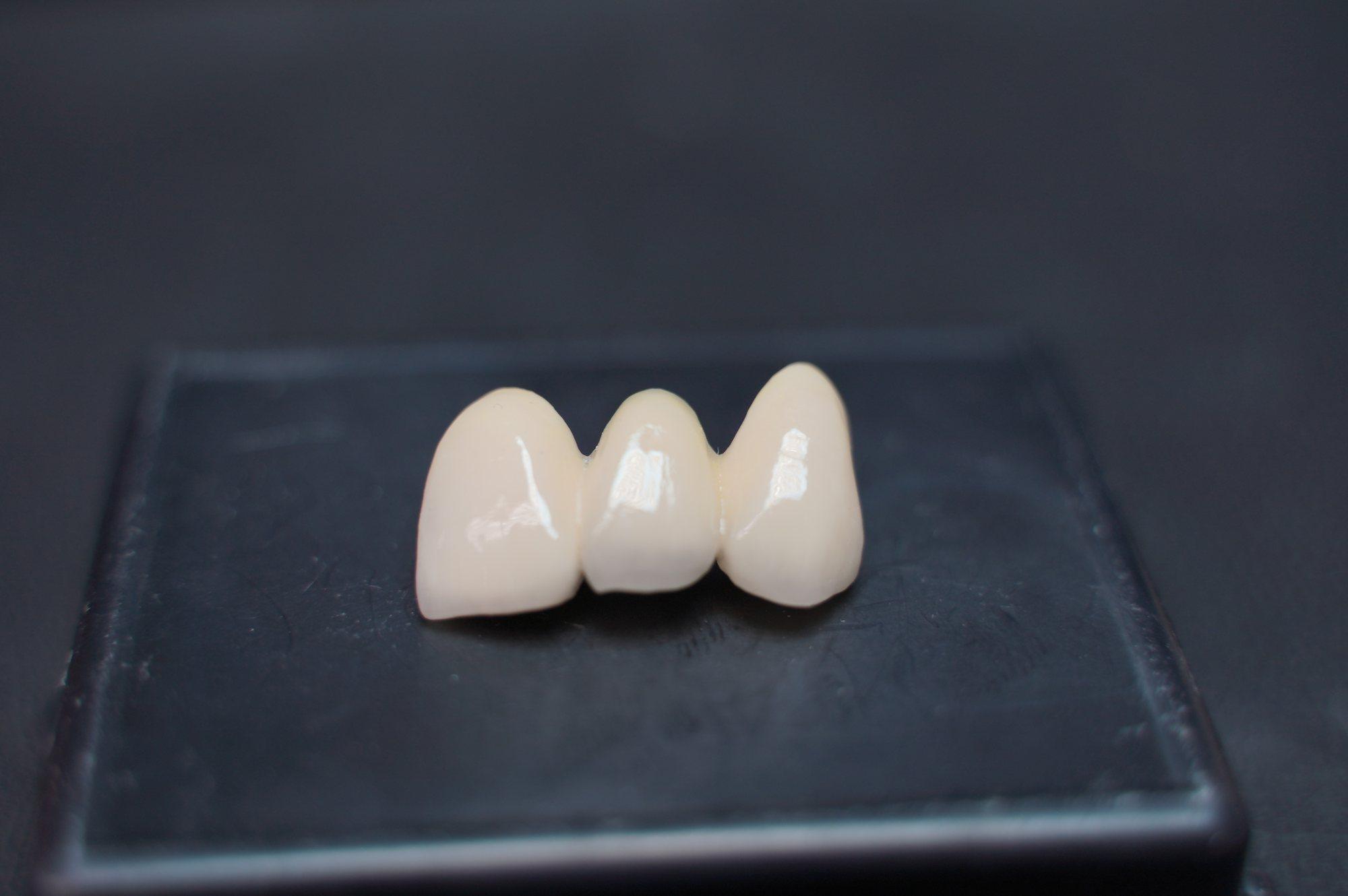 Anterior zirconia bridge photographed from the incisal edge