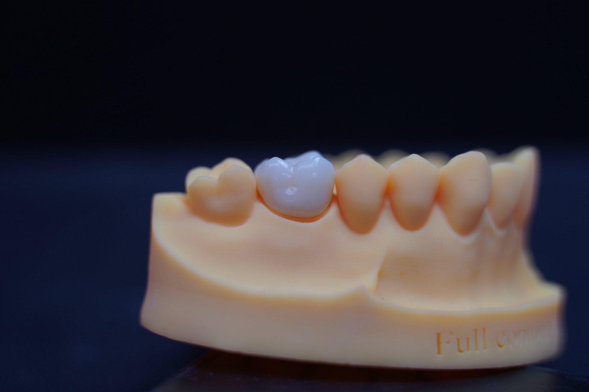 Zirconia molar crown seated on a dental model