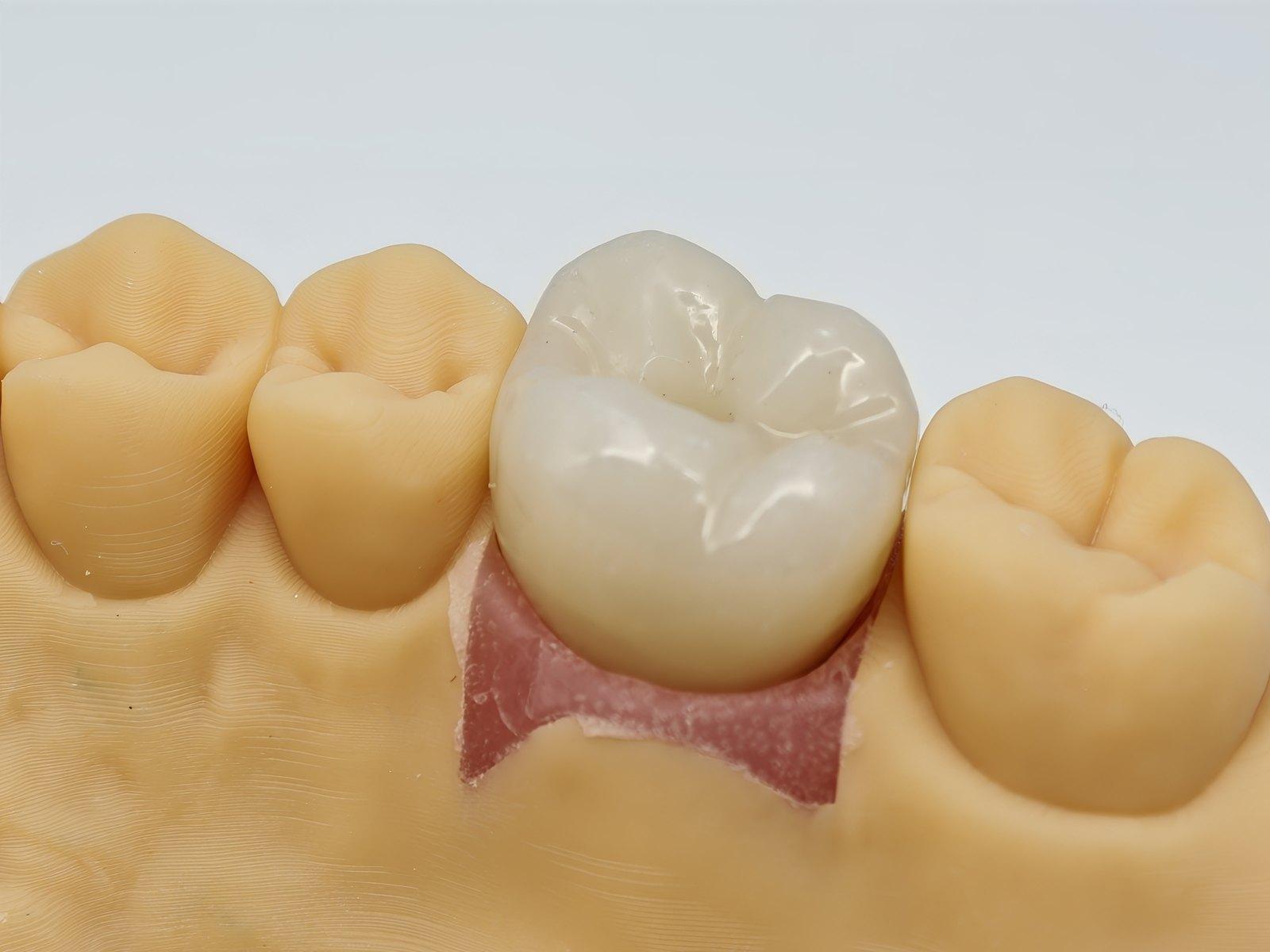Zirconia crown seated on a model, margin visible