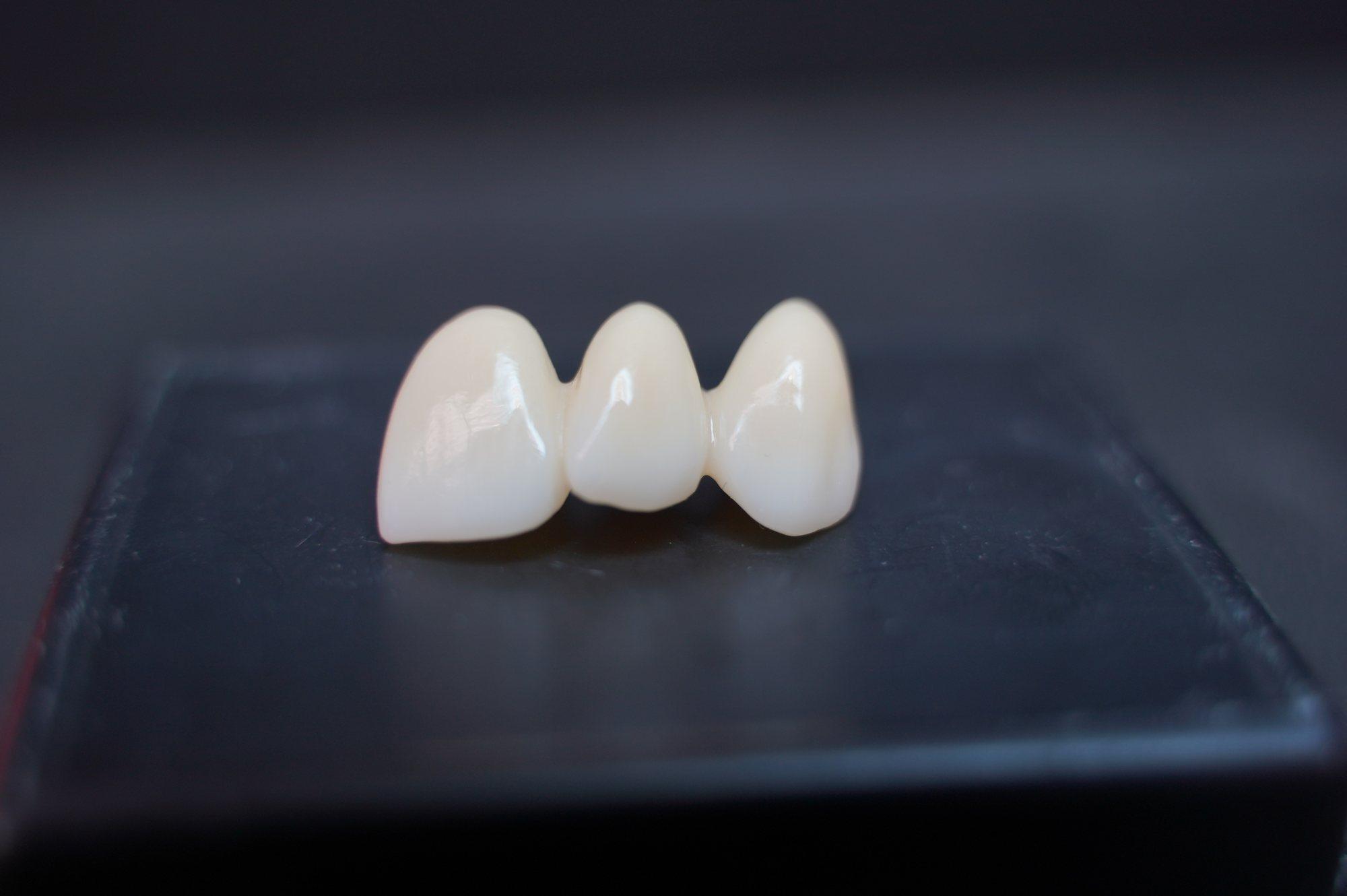 Three-unit anterior zirconia bridge