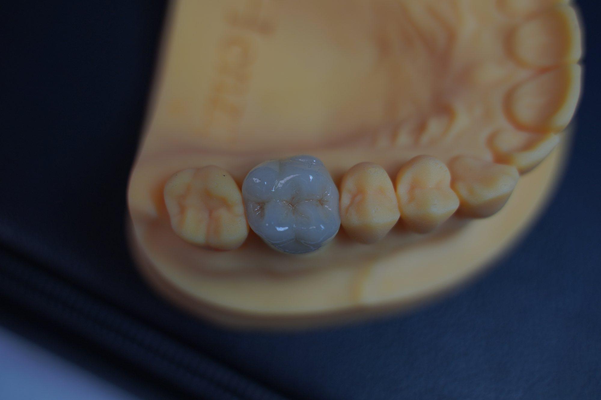 Single zirconia crown seated on a dental model